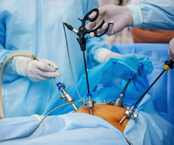 Laparoscopic Hysterectomy (Uterus Removal Keyhole Surgery)   in Kerala, A Painless Revolution.