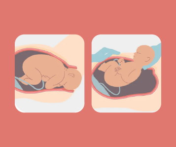 Natural Childbirth vs. C-Section: Pros and Cons